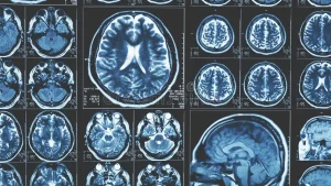 Brain Injury Lawyer in Winter Haven