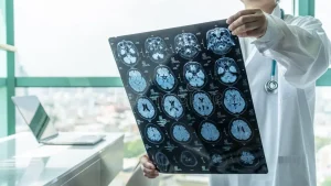 Winter Haven Brain Injury Attorney